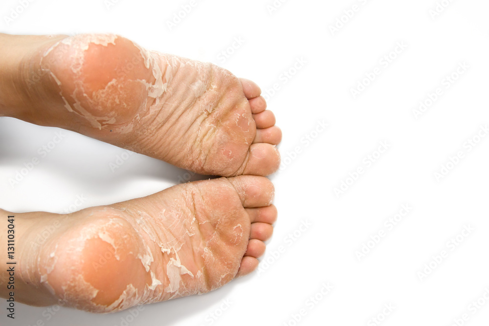 Cracked skin on heels. Cracked skin on heels.