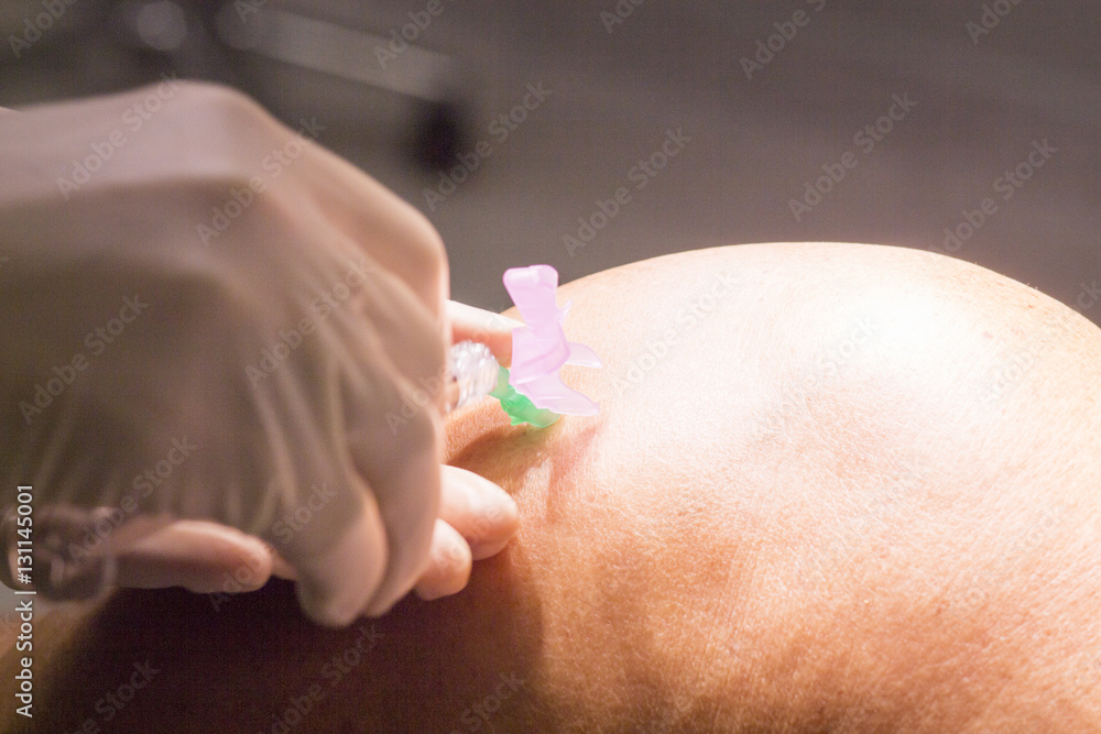 Anaesthetic injection in surgery Anaesthetic injection in surgery