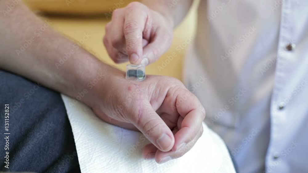 Medical leeches in a transparent flask on the patient's skin. Medical leeches in a transparent flask on the patient's skin.