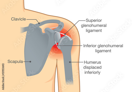 Dislocation Shoulder symptoms or separated. Bone and joints to slipping out of place.