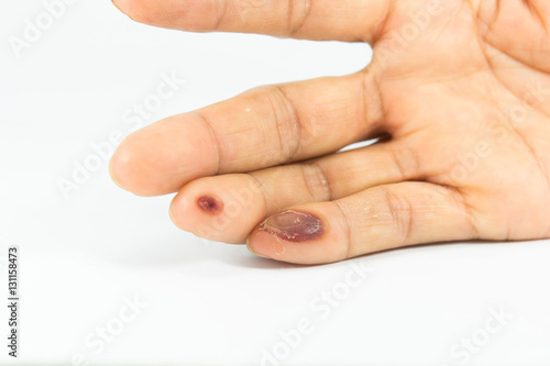 blisters on finger caused by electric shock
