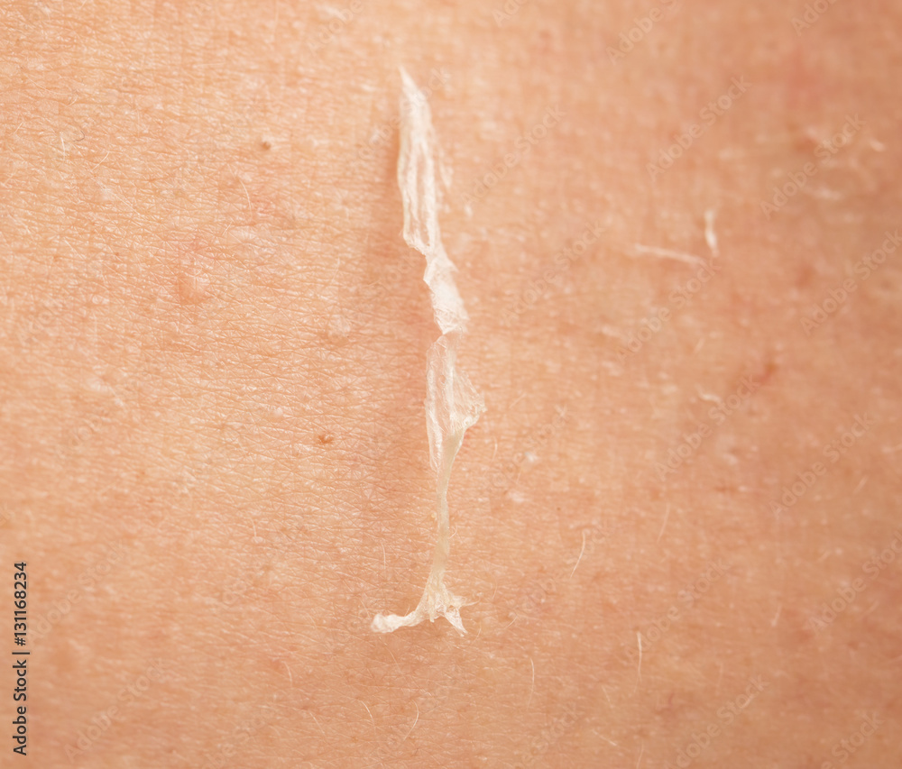 Fototapeta premium skin peeling after sunburn