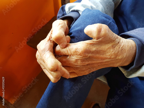 closeup two hands of asian old man suffering from leprosy, Thailand. photo