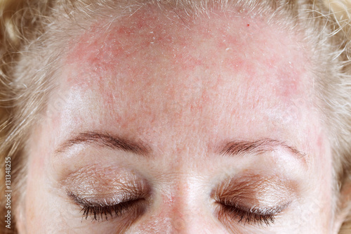Fotografering Mature woman's very dry & peeling skin with seborrheic dermatitis