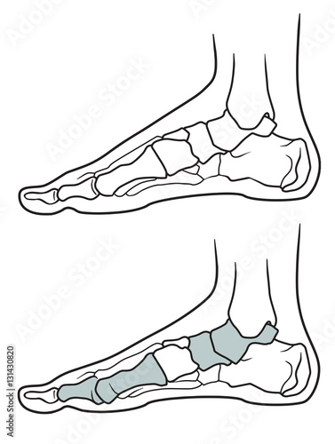 Flatfoot, The structure of the legs with flat feet and normally feet  on a white background
