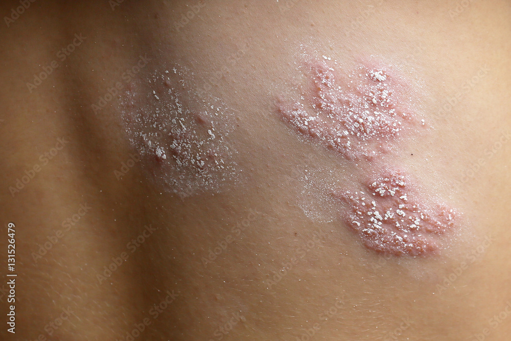Fototapeta premium Symptoms of shingles on his back