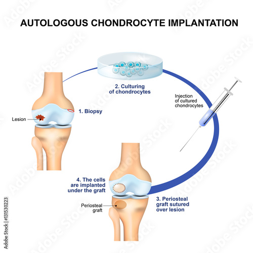 Fotografia Autologous Chondrocyte Implantation