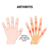 Hand with arthritis