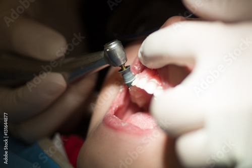 Teeth polishing treatment, dentistry