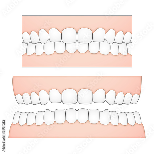 Anatomical vector illustration of isolated white teeth and gums from frontal perspective. Each tooth is a single object so that missing ones or gaps can be desplayed for medicine or dentist graphics.