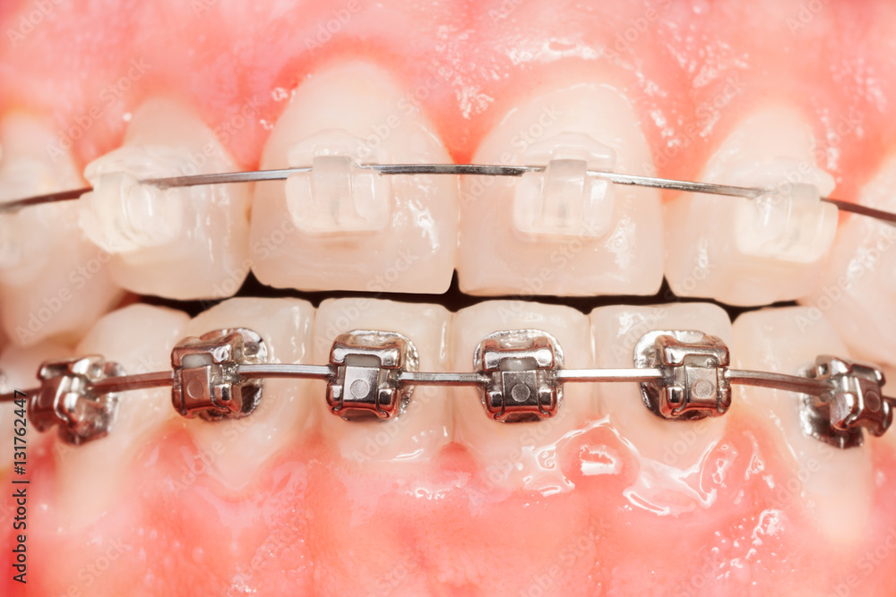 Fototapeta premium Tooth alignments with ceramic and metal braces