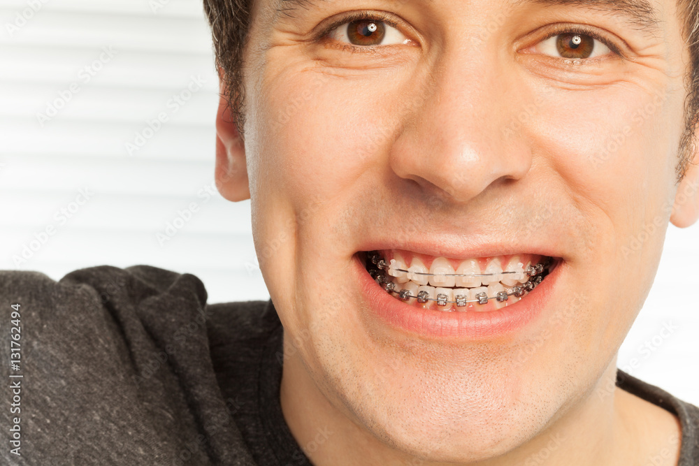 Naklejka premium Young man with dental braces on his teeth