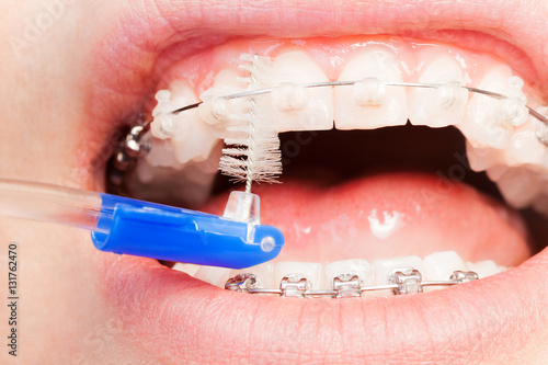 Using an interdental brush for orthodontic braces