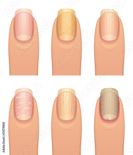 Nail disease set