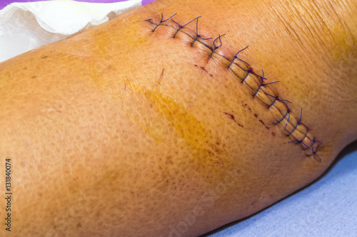 scar from operation suture with a blue fiber at leg patient photo