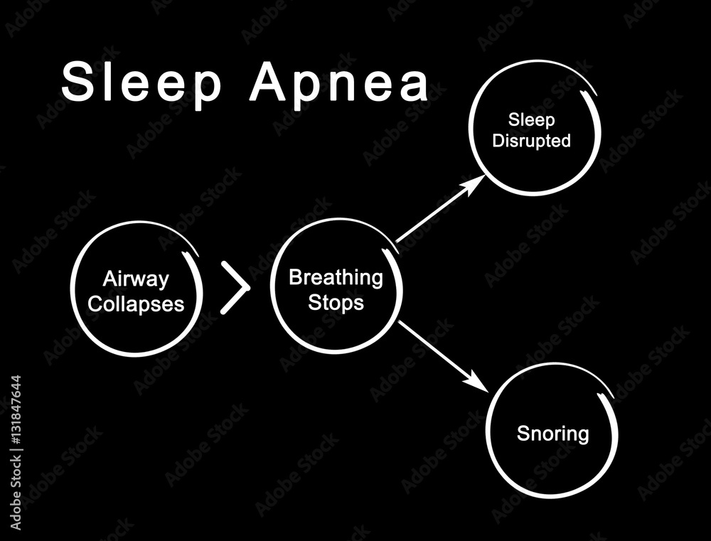 Sleep Apnea
