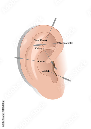 acudetos: an acupuncture method to help people quit smoking or drugs
