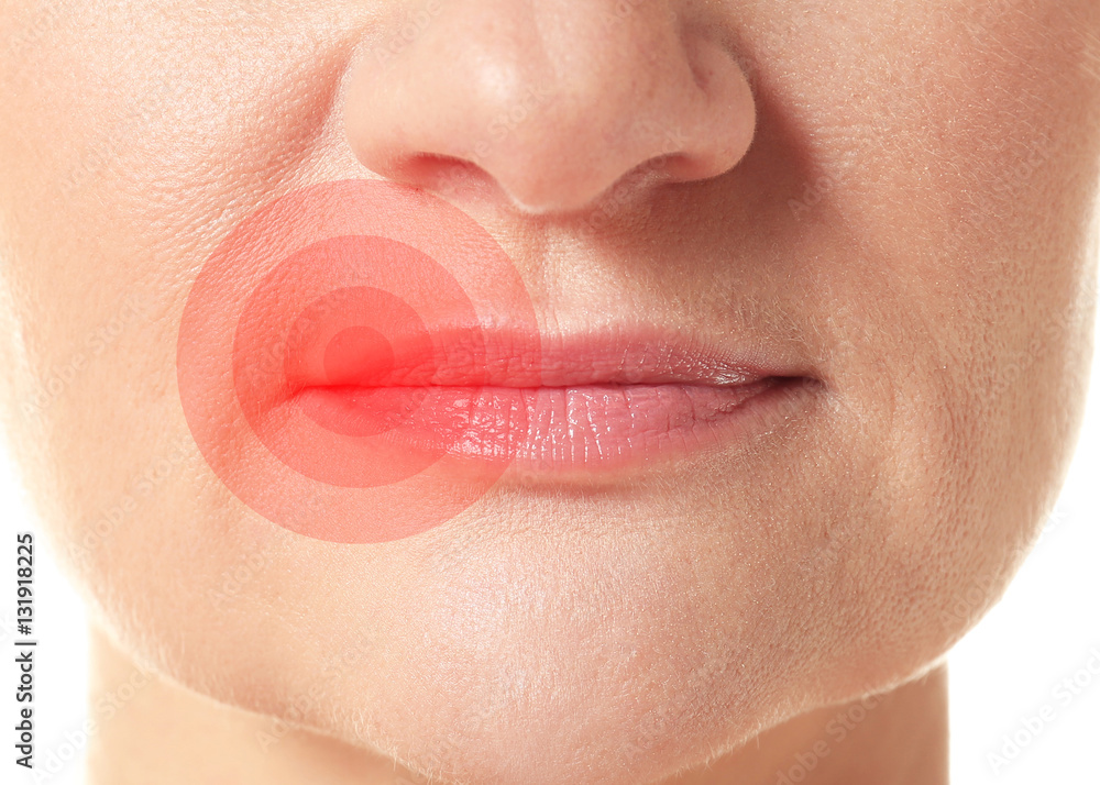 Obraz premium Female lips with herpes virus, closeup