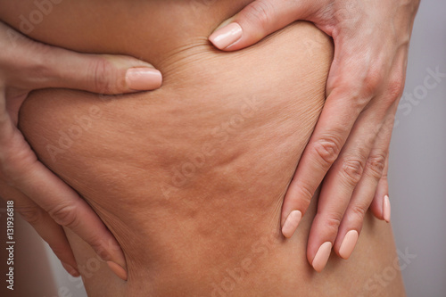 Girl shows holding and pushing the skin of the legs cellulite, orange peel. Treatment and disposal of excess weight, the deposition of subcutaneous fat tissue
