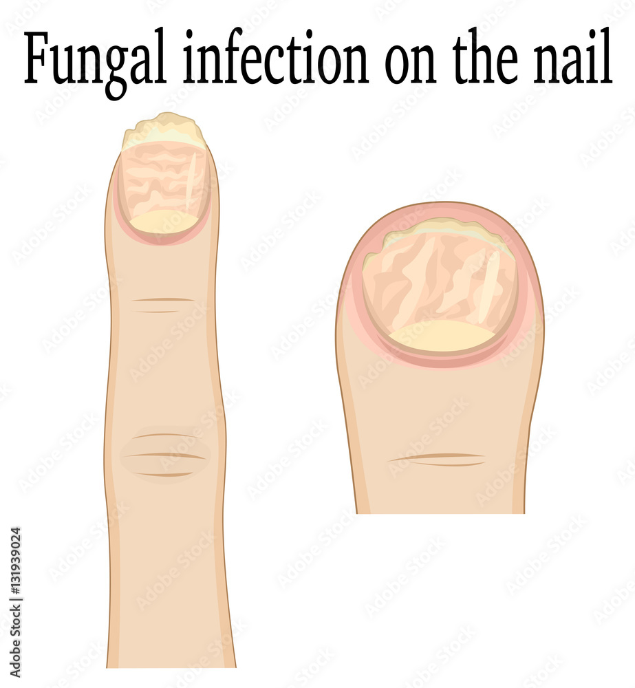 Fungal infection on the fingers of the feet and hands Stock Vector ...