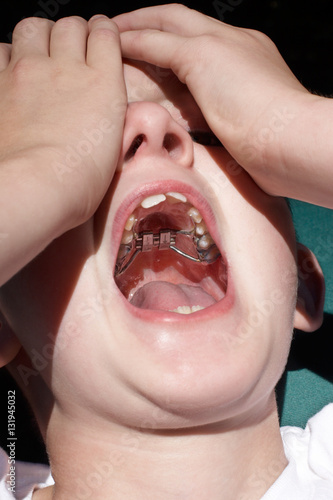 Obraz na plátně Boy opens mouth ready to have his palatal expander adjusted