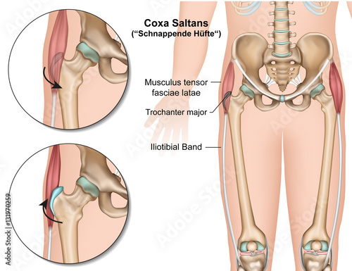 Coxa saltans, schnappende Hüfte medical vector  illustration 