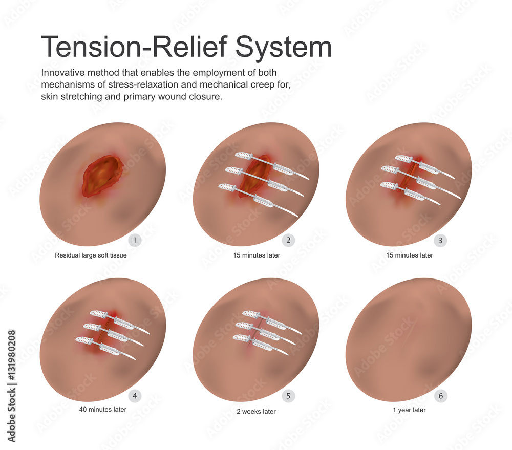 Obraz premium tension relief system