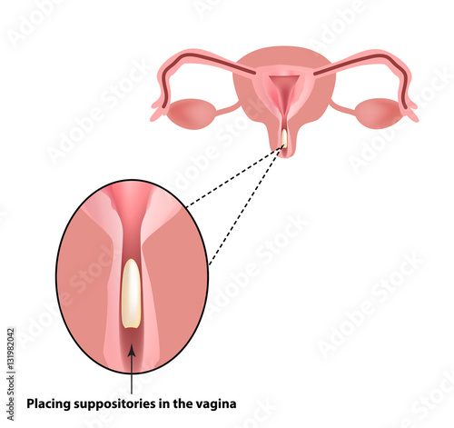 Treatment of vaginitis suppositories. inflammation  the vagina. Infographics. vector illustration on isolated background