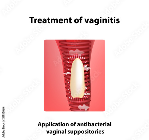 Treatment of vaginitis suppositories. inflammation  the vagina. Infographics. vector illustration on isolated background