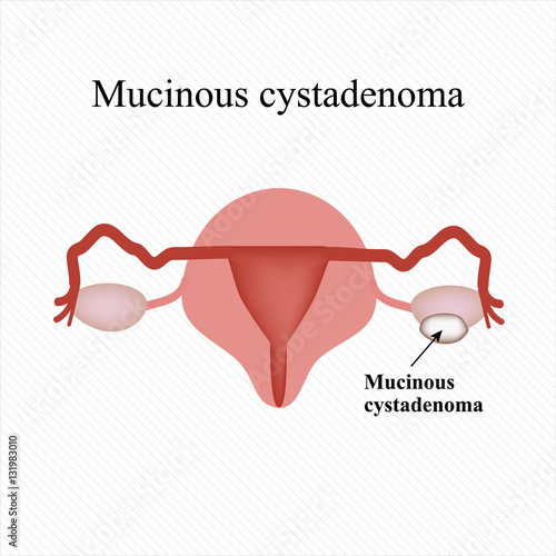 Mucinous cyst on the ovary. Cystadenoma. . Infographics. Vector illustration