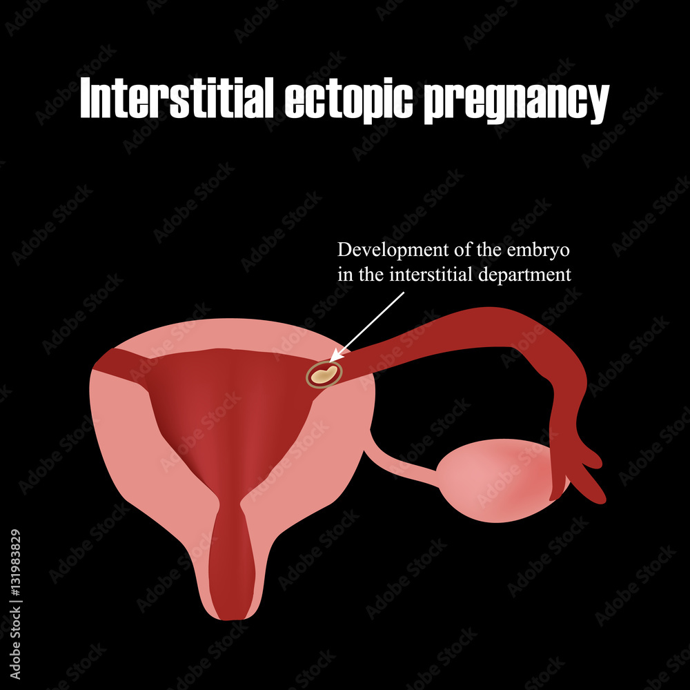 Development Of The Embryo In The Interstitial Department Ectopic