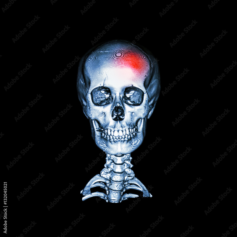 Stroke . CT scan with 3D image of human skull and cervical spine . anterior - posterior view ( AP ) . Stroke . CT scan with 3D image of human skull and cervical spine . anterior - posterior view ( AP ) .