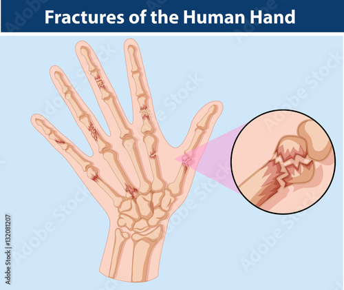Diagram of fractures in human hand