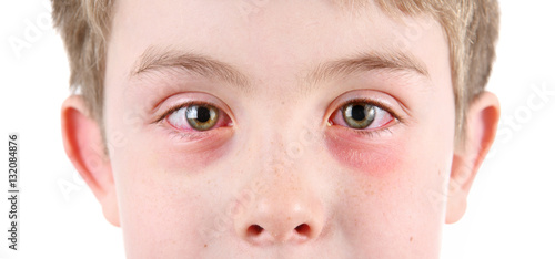 Boy with conjunctivitis photo