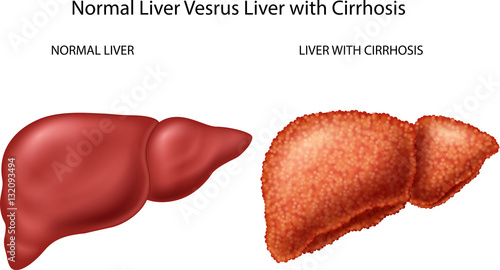 Normal liver versus liver with Cirrhosis

