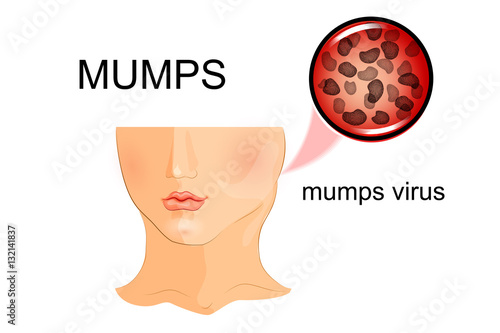 illustration of a child affected by mumps. virus photo