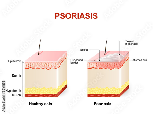 Psoriasis
