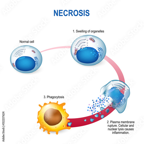 necrosis