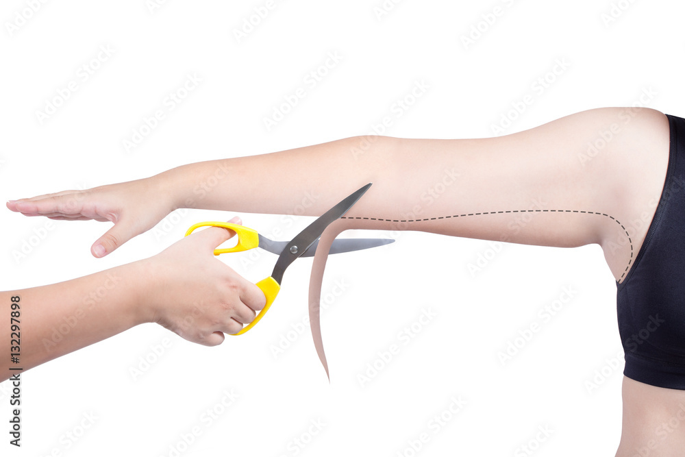 fat woman surgery mark arm cut body fat plastic surgery liposuction