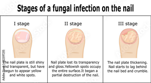 Three stages of development of fungal infection on nail of the toe