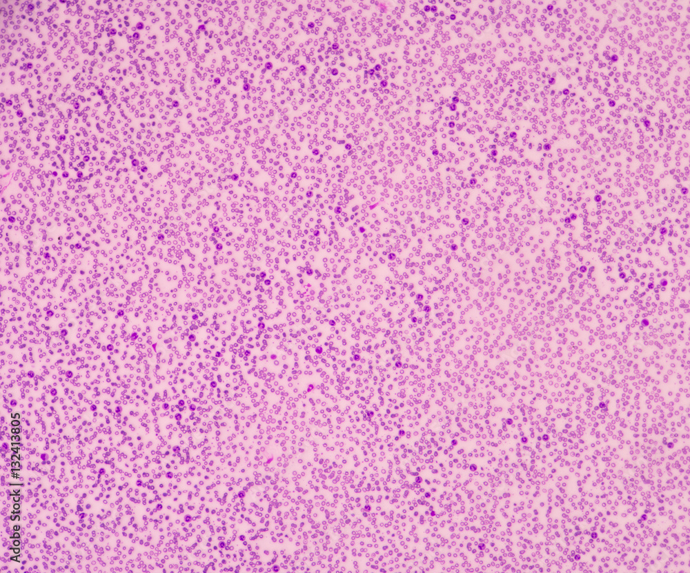 Sepsis or septicaemia is a life-threatening illness. Sepsis or septicaemia is a life-threatening illness.