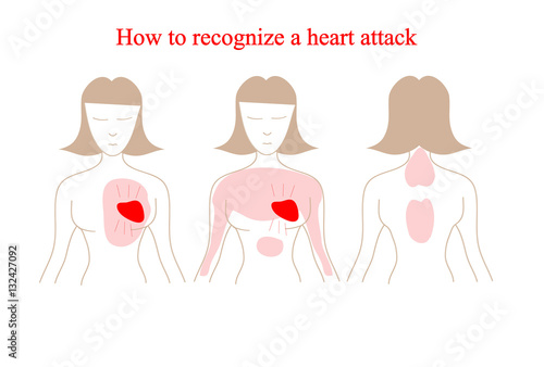 Heart attack vector infographic. Heart attack symptoms. How to recognize a heart attack
