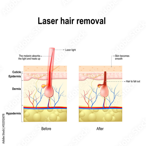 Laser Hair Removal. Vector diagram