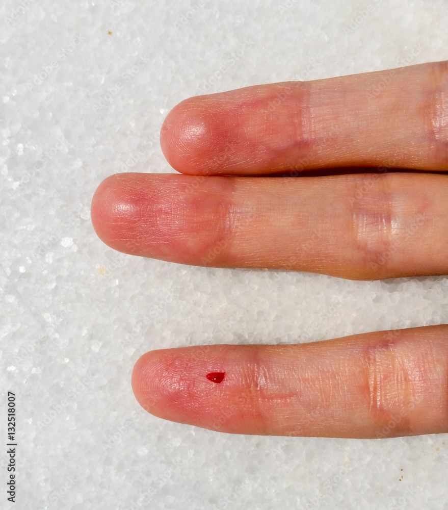 Closeup of female finger with blood drop for blood testing Closeup of female finger with blood drop for blood testing