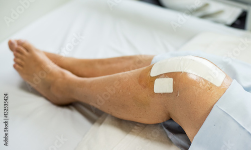 Close up- Knee replacement surgery after operation patient on the bed in hospital
