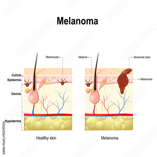 Melanoma or skin cancer.