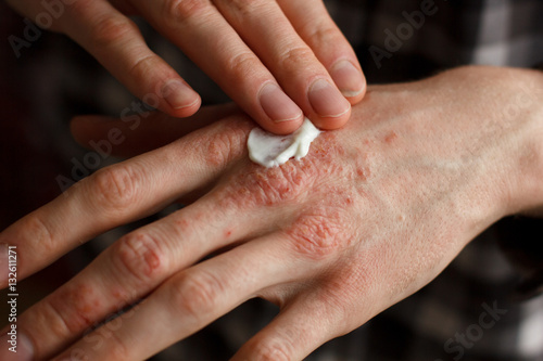 applying an emollient to dry flaky skin as in the treatment of psoriasis, eczema and other dry skin conditions
