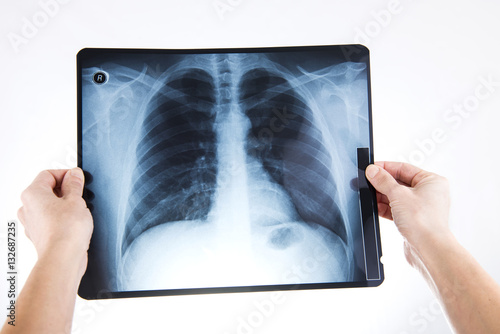 X-ray of lungs doctor holding in hands