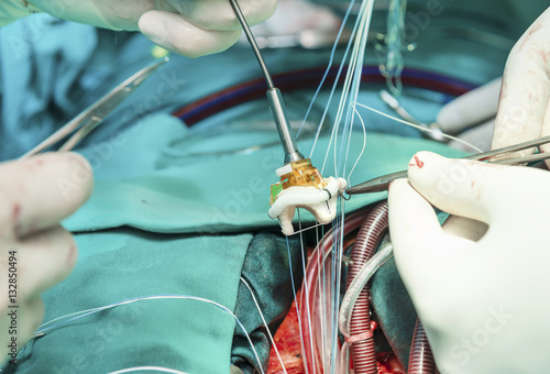 Принти на полотні Placing stiches on artefitial heart valve