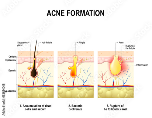 acne formation. human skin.